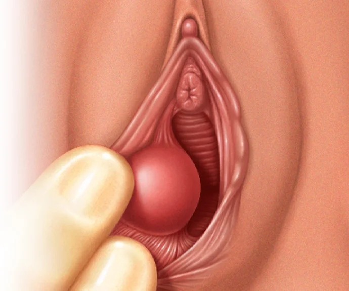 vaginal cyst